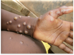 Togo Confirms First Case of Mpox at Lomé