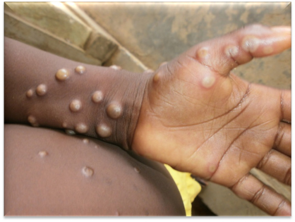 Togo : un premier cas de Mpox confirmé à Lomé