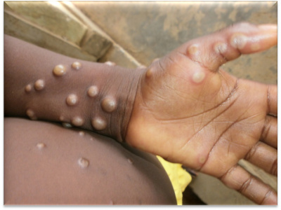 togo-un-premier-cas-de-mpox-confirme-a-lome