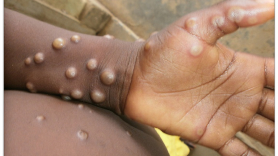 Togo : un premier cas de Mpox confirmé à Lomé