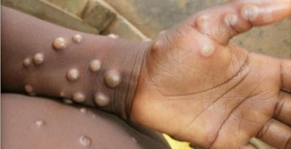 Togo prepares to face monkeypox as several countries in the West and Africa deal with the virus