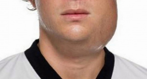 Togo : des cas d&rsquo;oreillons d&eacute;tect&eacute;s